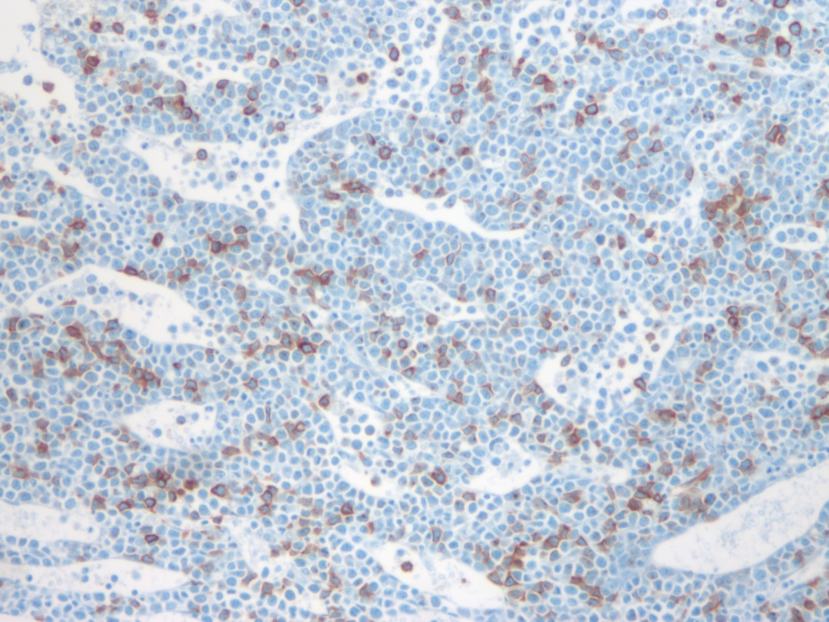 Bone marrow biopsy CD34